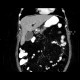 Acute cholecystitis, CT: CT - Computed tomography